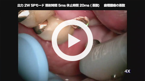 歯槽膿瘍の蒸散