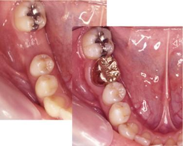欠損歯列をつくらない、拡大させない臨床