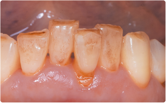 歯の表面のステイン