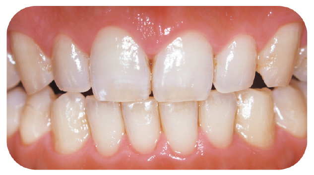 歯と歯茎のイメージ画像