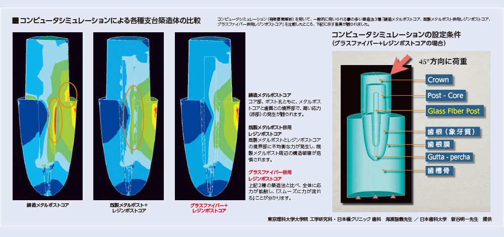 コンピュータシュミレーションによる各種支台築造体の比較