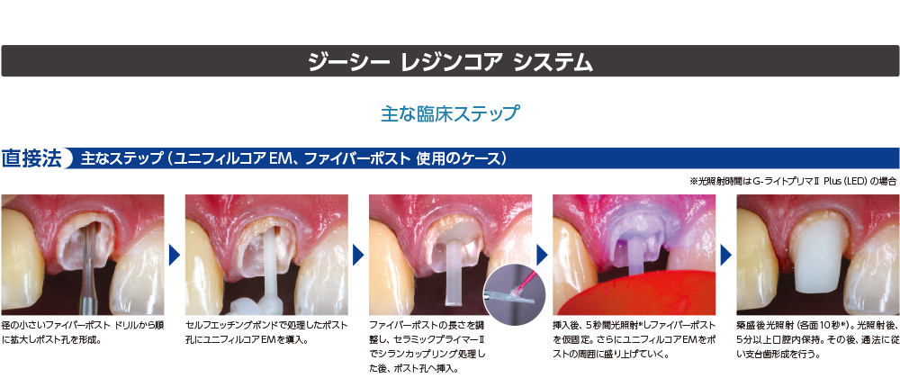 ジーシー レジンコア　システム　直接法