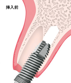 GENESiO Plus抜歯窩埋入例