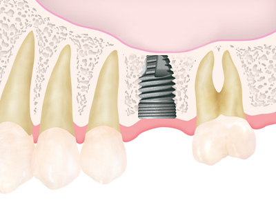 Short&Nerrow Implant