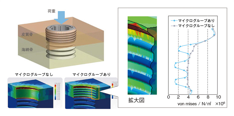 インプラント体カラー部の有限要素解析