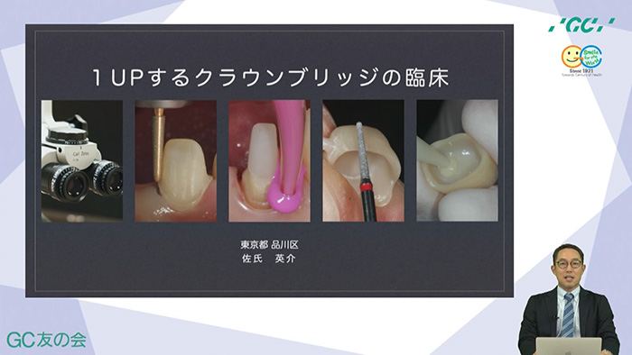 GC Webセミナー 1UPするクラウンブリッジの臨床の動画リンク