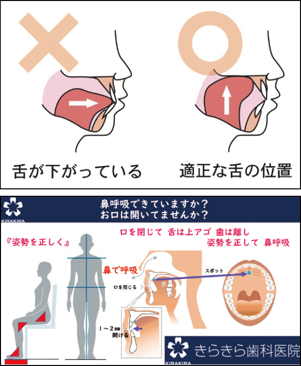 配付資料 口呼吸の習癖改善のため正しい舌位・スポットを説明