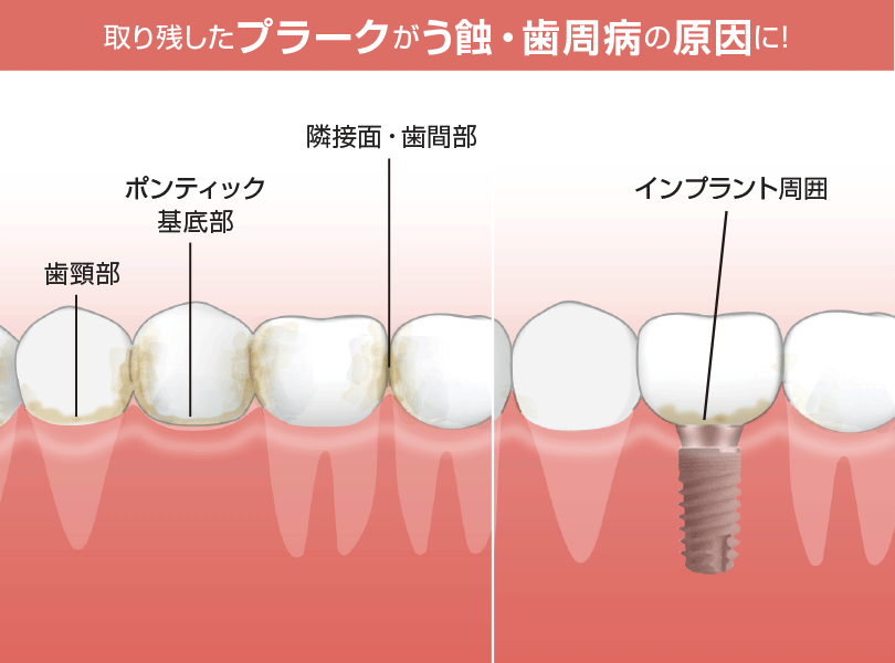 歯間清掃用具のひみつ | ルシェロ（ruscello®） | 株式会社ジーシー