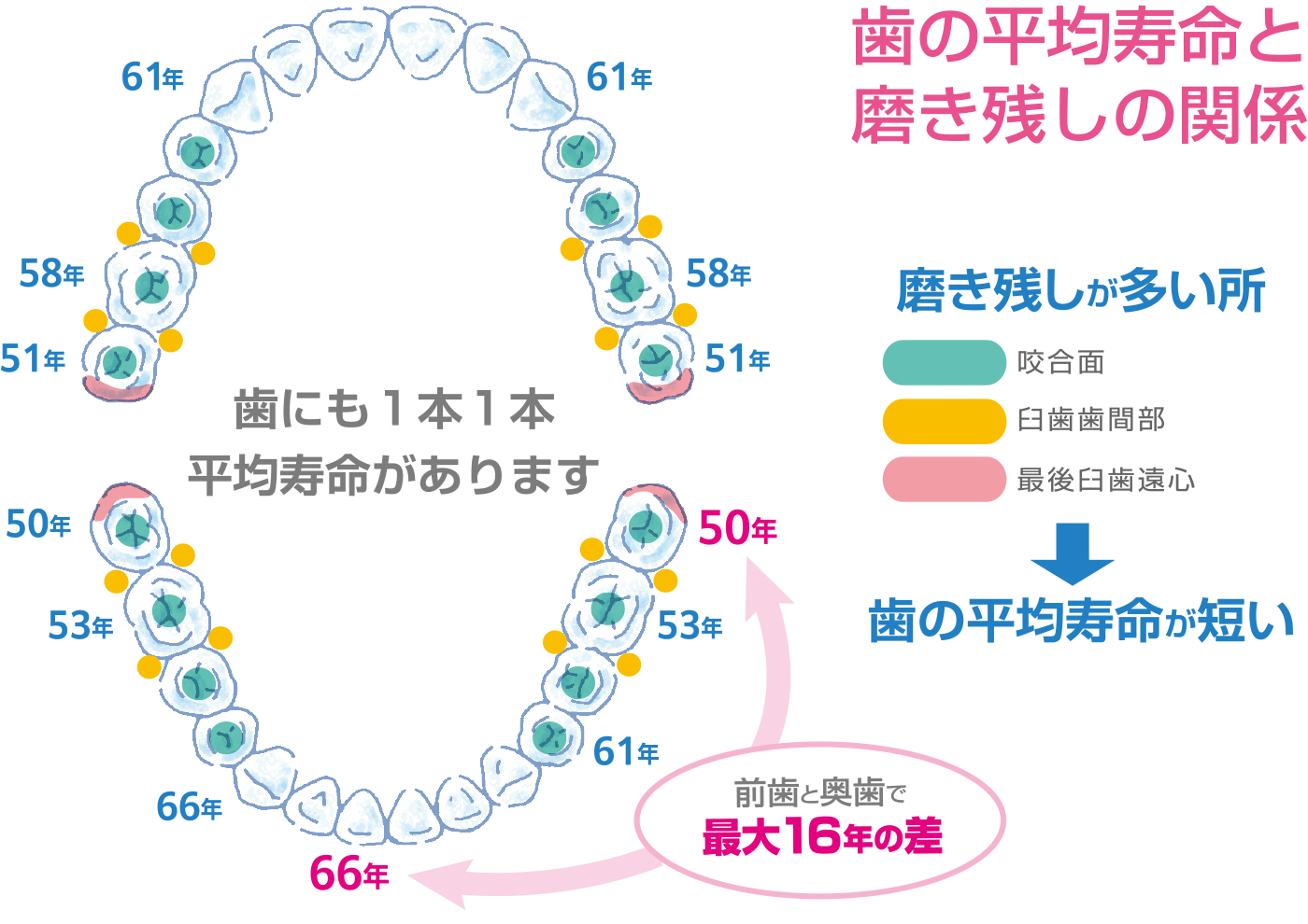 歯の平均寿命と磨き残しの関係