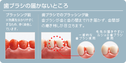 フロスの必要性 ご使用方法 ルシェロ歯ブラシ フロスの必要性 ご使用方法 ルシェロ歯ブラシ
