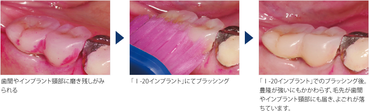 ブラシの特長：I-20｜ルシェロ歯ブラシ