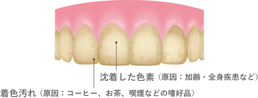 沈着した色素（原因：加齢・全身疾患など）、着色汚れ（原因：コーヒー、お茶、喫煙などの嗜好品）